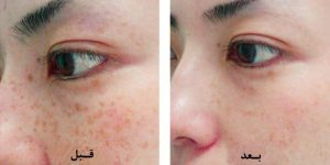 درمان لک های پوستی با درمان پزشکی